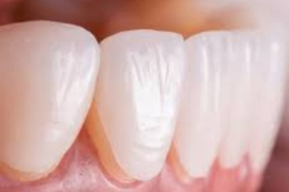 Ceramic Crowns & Caps