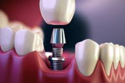 Dental Implants