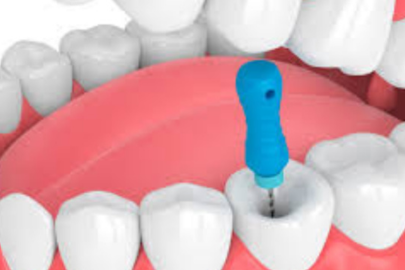 Root Canal Therapy