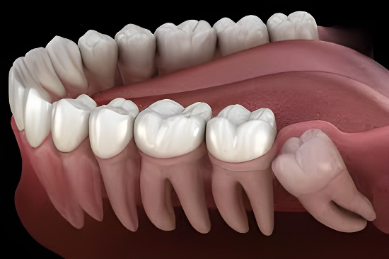 Tooth Extractions & Impactions