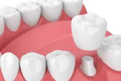 Zirconia Crown
